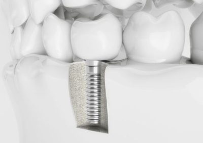 woodland hills dental implants