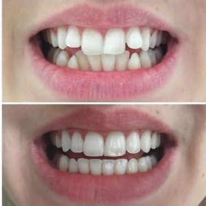 invisalign before and after